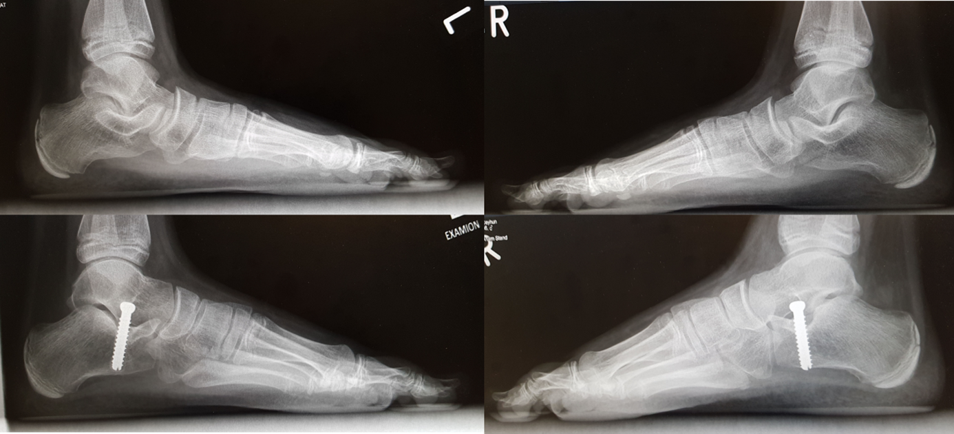 Abbildung 1 zeigt die Röntgenbilder im Stehen von 2 Jungen vor (oben) und nach ( unten) Calcaneus- Stopp Schraube Schraube. Zu sehen ist eine deutliche Aufrichtung der Längswölbung.
